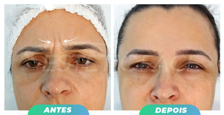 botox---glabela-01.jpg