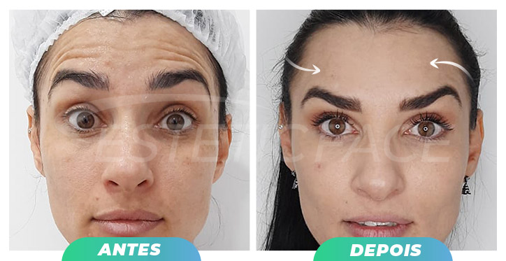 botox---linhas-frontais-01.jpg
