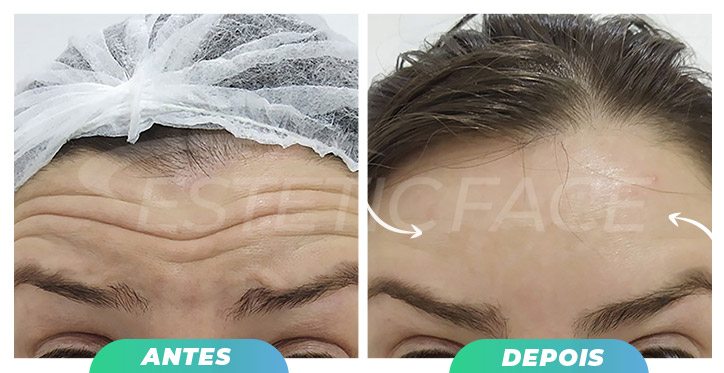 botox---linhas-frontais-02.jpg