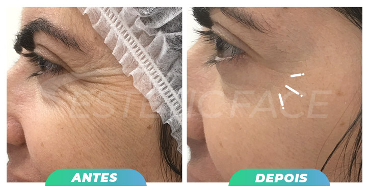 botox---pes-de-galinha-03.jpg