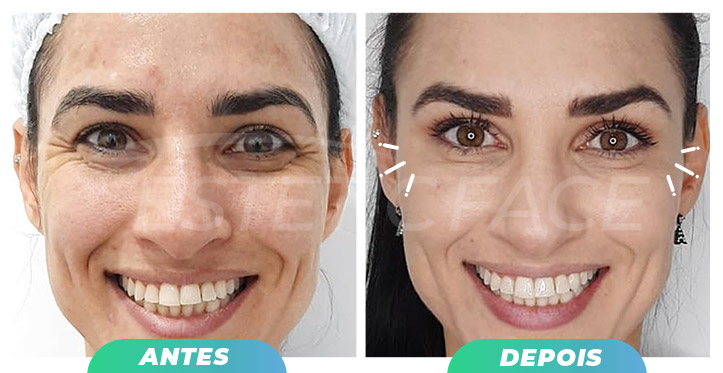 botox---pes-de-galinha-04.jpg