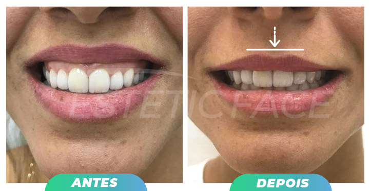 botox---sorriso-gengival-01.jpg