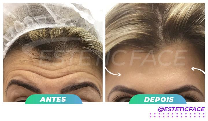 botox-linhas-de-frontais-03.jpg