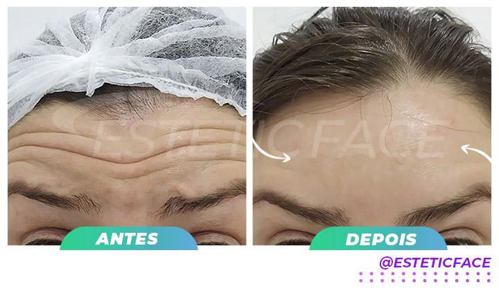 botox-linhas-frontais-01.jpg