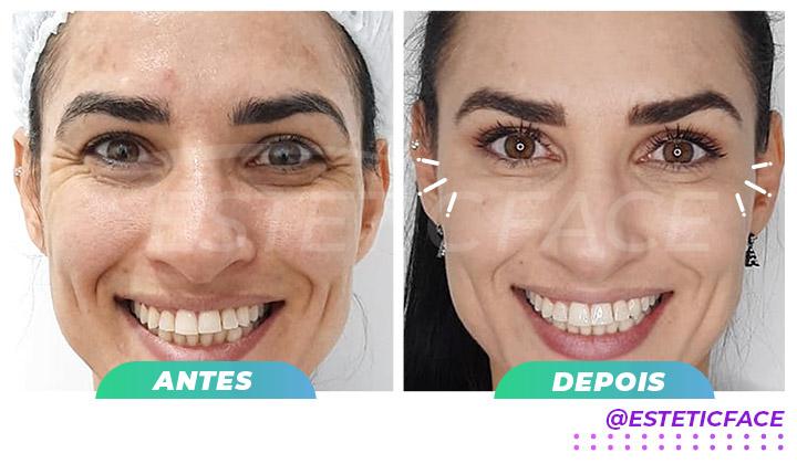 botox-ps-de-galinha-02.jpg