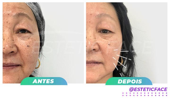 peeling-qumico-04.jpg