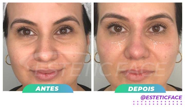 preenchimento-de-olheiras-01.jpg