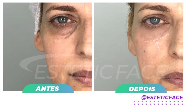 preenchimento-de-olheiras-03.jpg