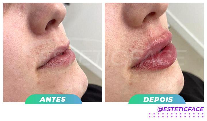 preenchimento-labial---antes-e-depois-estetic-face---01.jpg