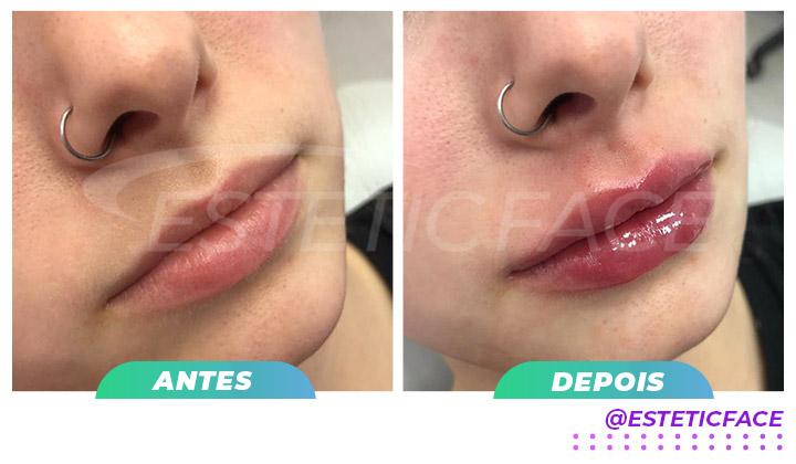 preenchimento-labial---antes-e-depois-estetic-face---02.jpg